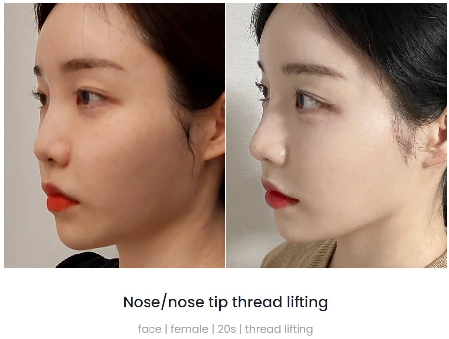 nose thread lift korea pang pang clinic