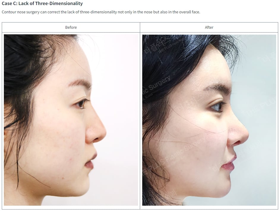 nose bridge surgery in korea before after