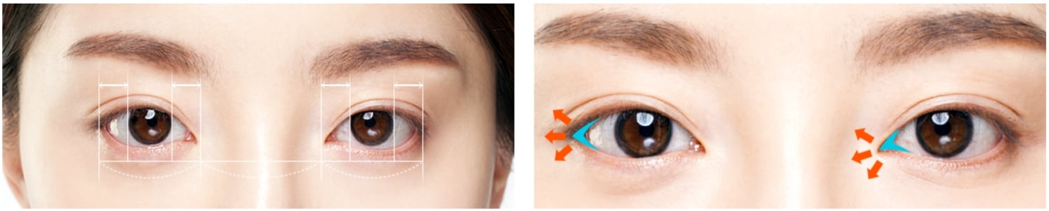 Canthoplasty in Korea eye surgery