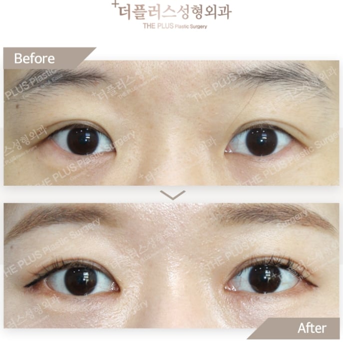 lateral canthoplasty korea