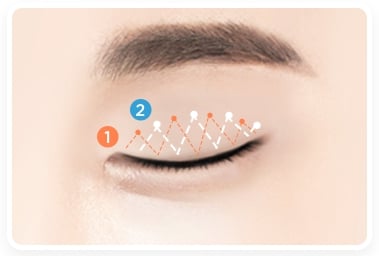 non incisional double eyelid surgery korea
