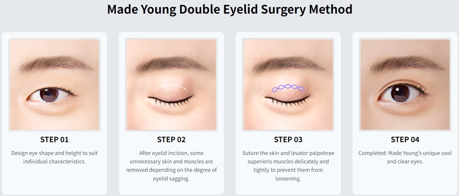 incisional double eyelid surgery korea