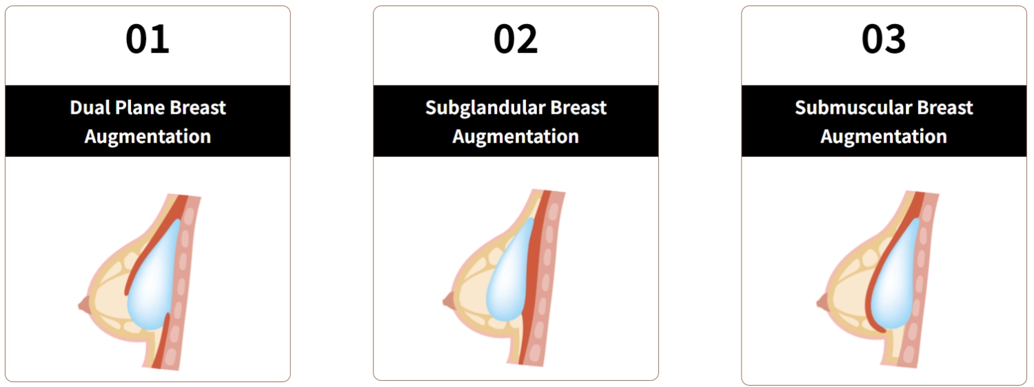 breast enlargement surgery korea