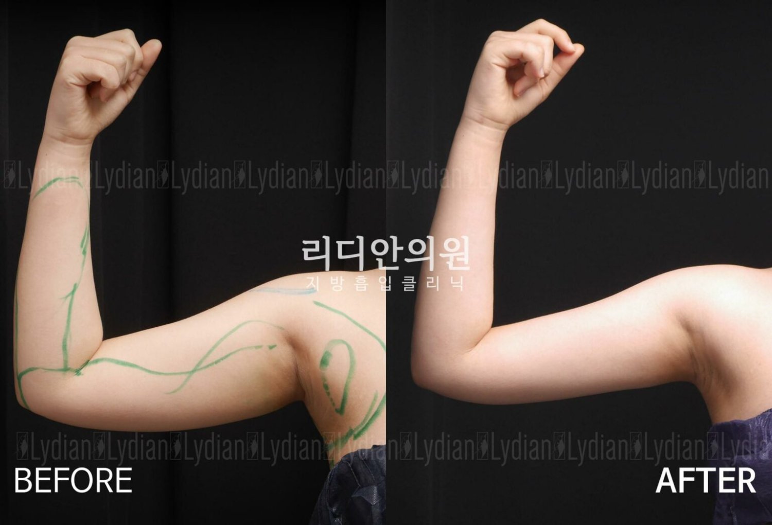 arm liposuction korea lydian before after