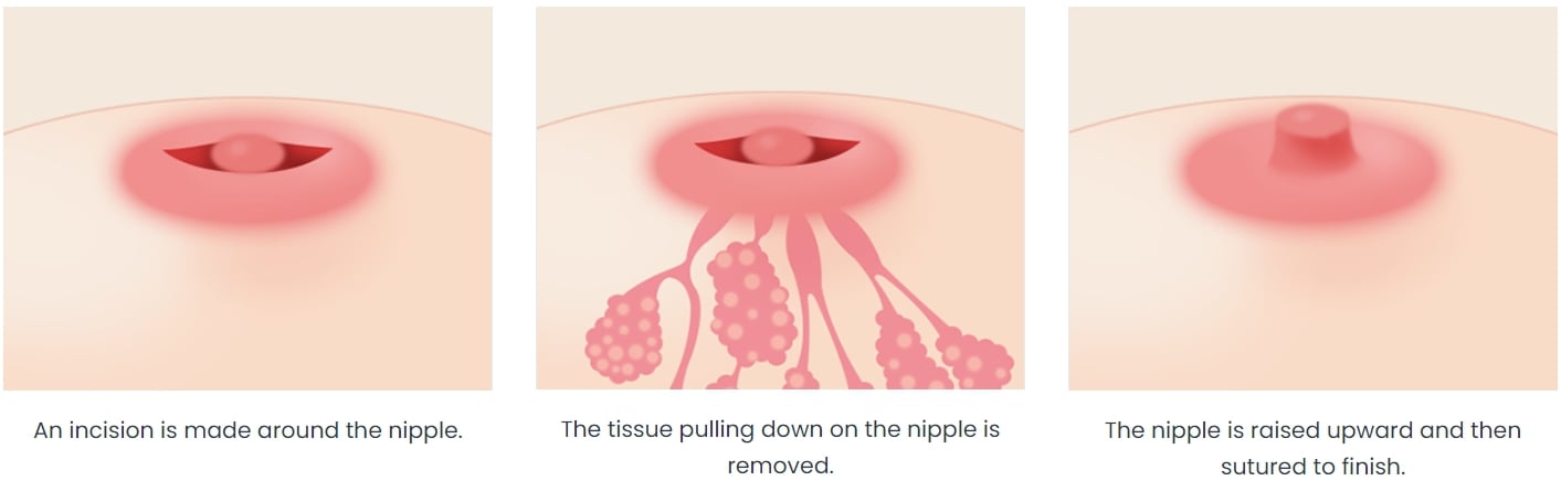 nipple surgery in korae