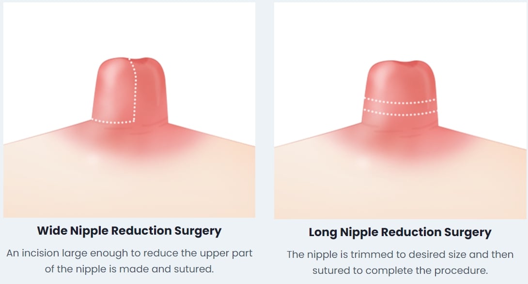 nipple surgery clinic korea