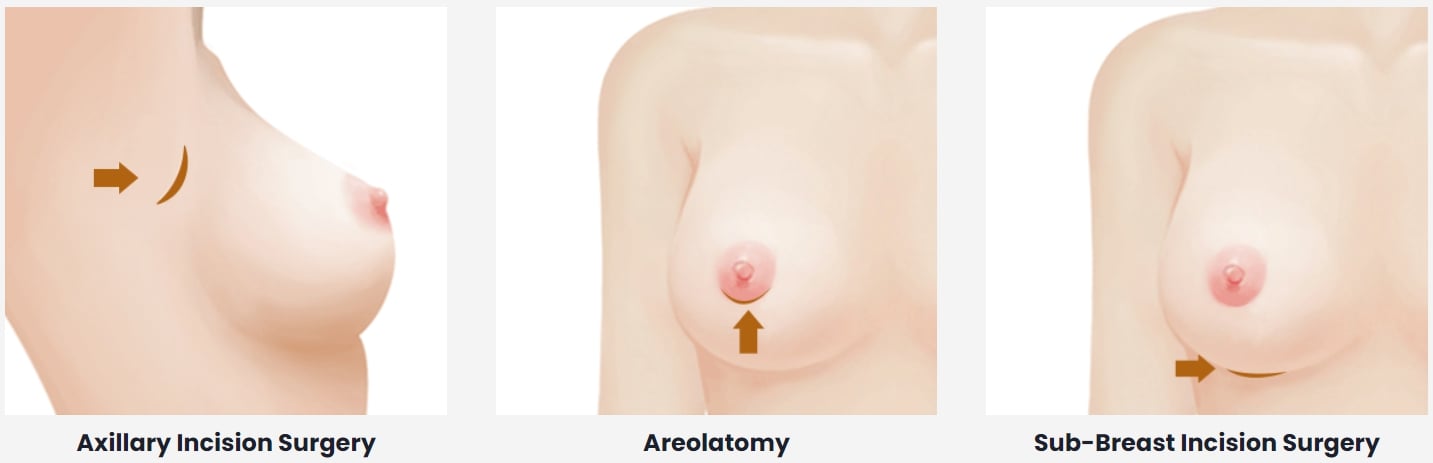 Breast Augmentation in Korea  Procedure Types, Best Clinics