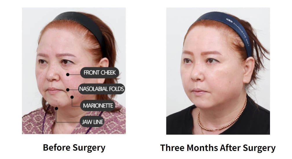 facelift in korea before after made young clinic