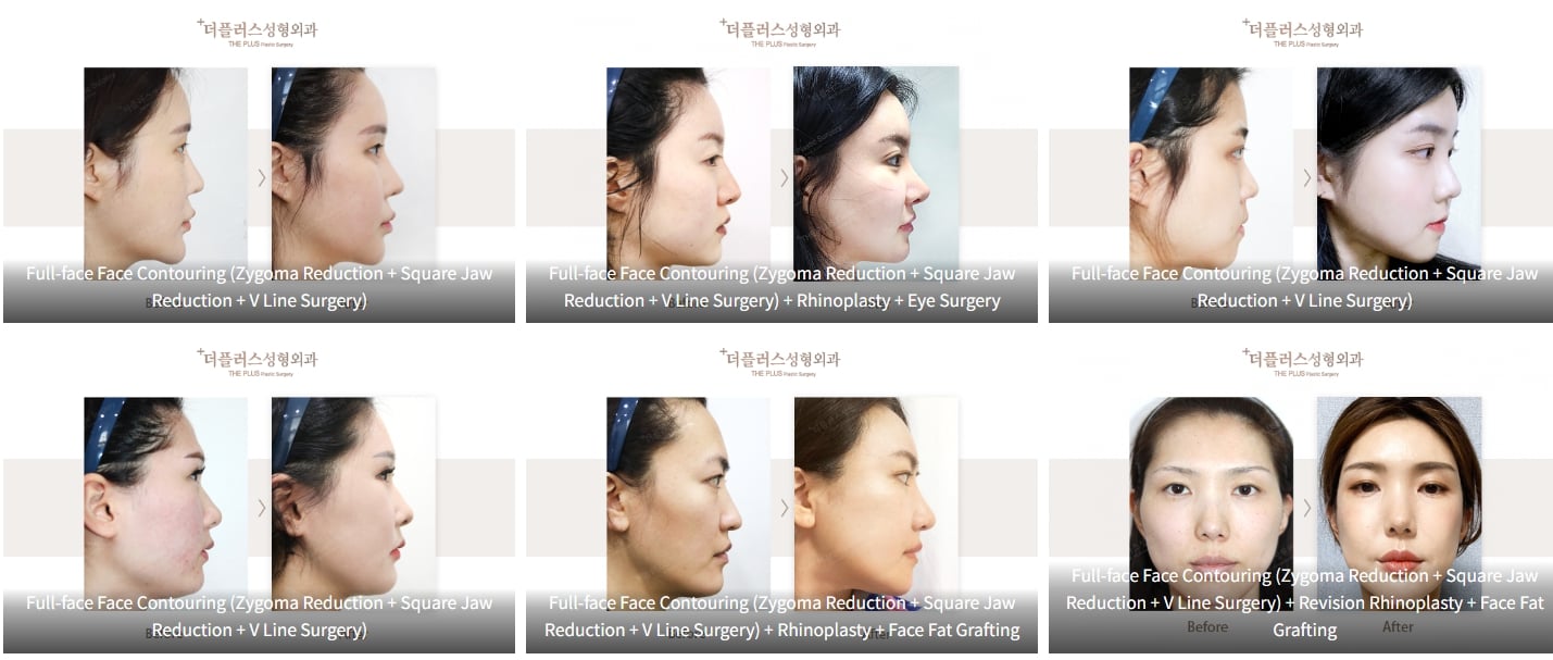 korean jaw surgery before after