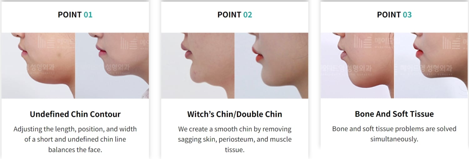 korean chin surgery