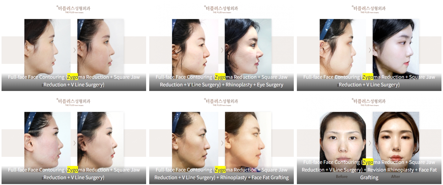 cheekbone reduction surgery korea before after