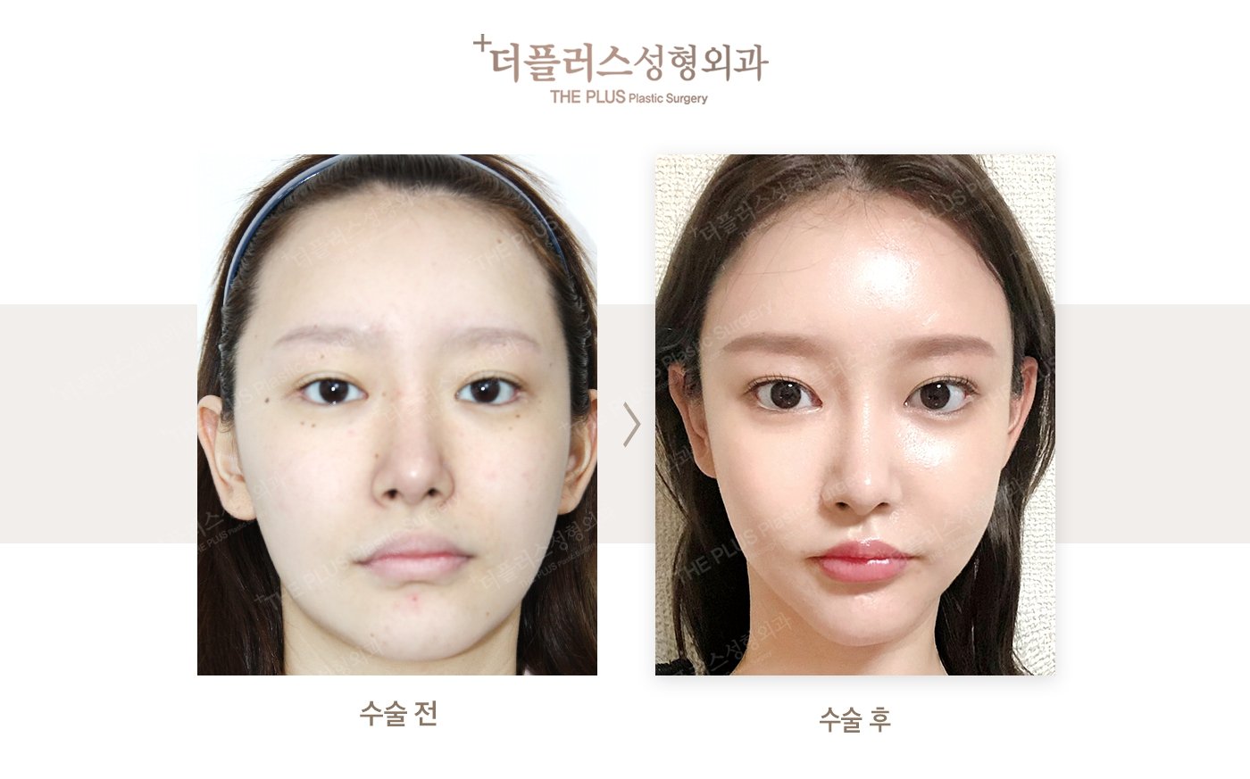 jaw implant korea before after