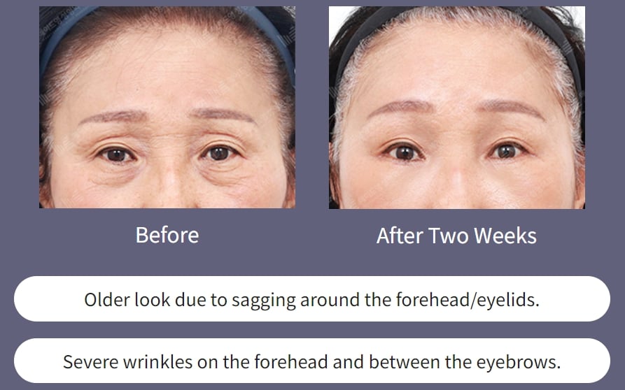 forehead lift korea before after