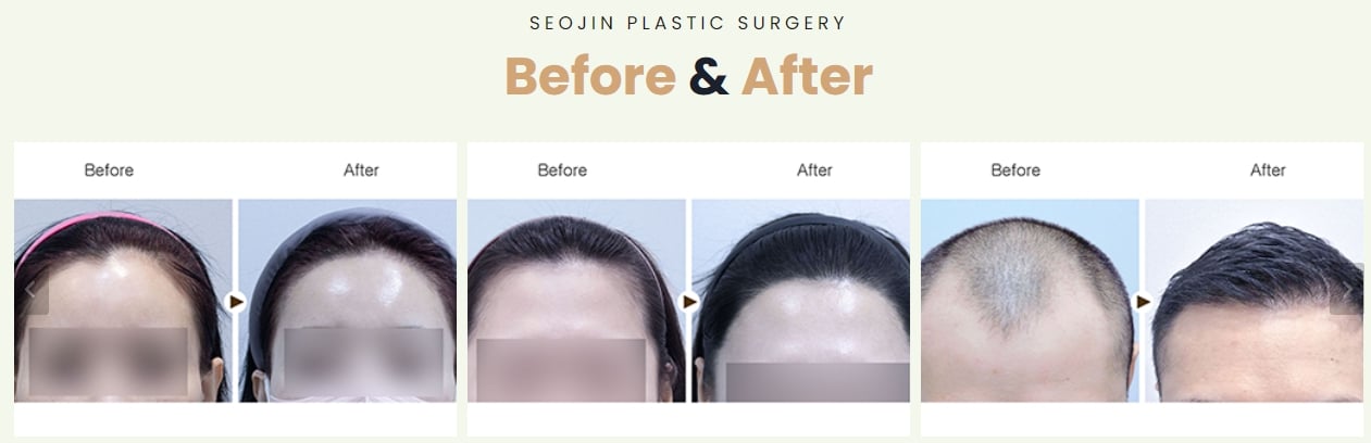 hair loss treatment korea before after