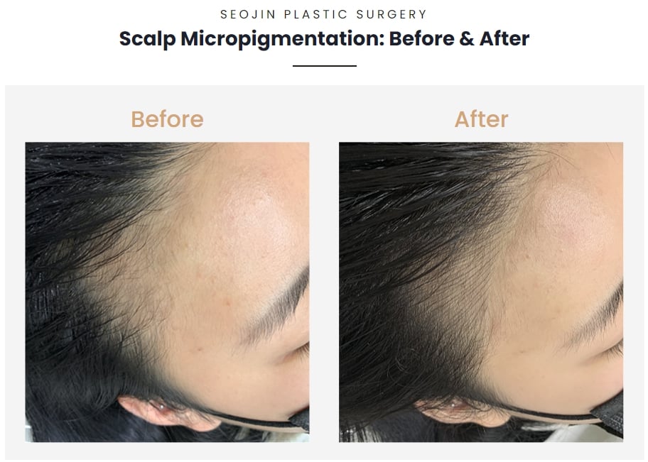 scalp micropigmentation in korea before after
