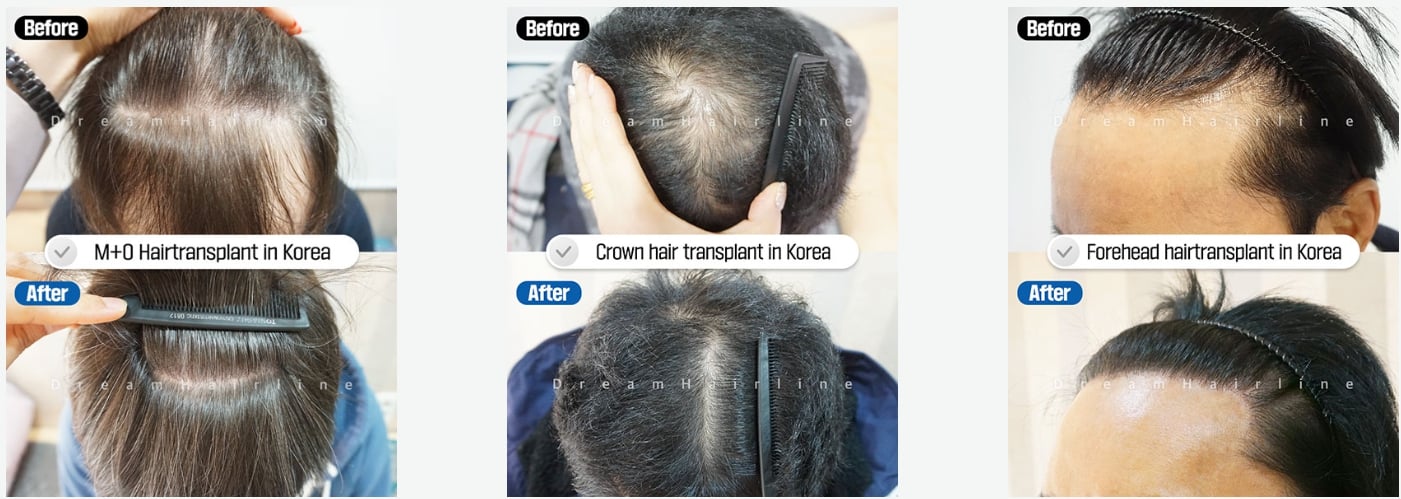best hair transplant singapore