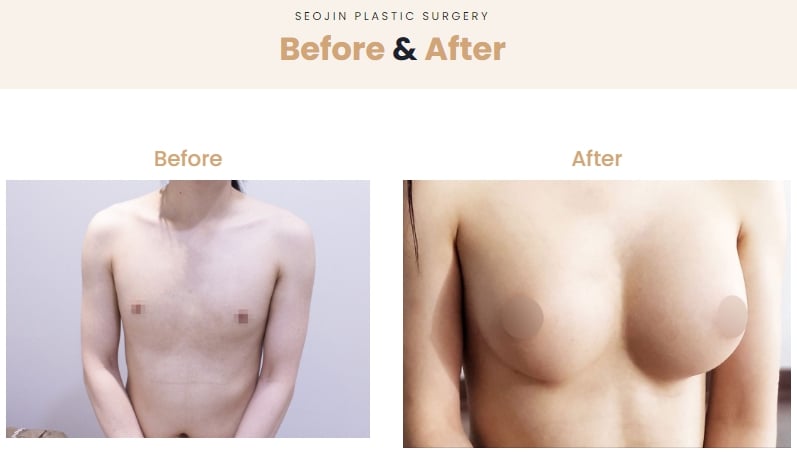 transgender surgery singapore before after