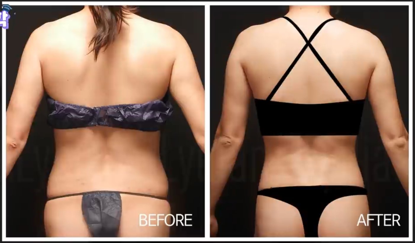 full body liposuction korea before after 