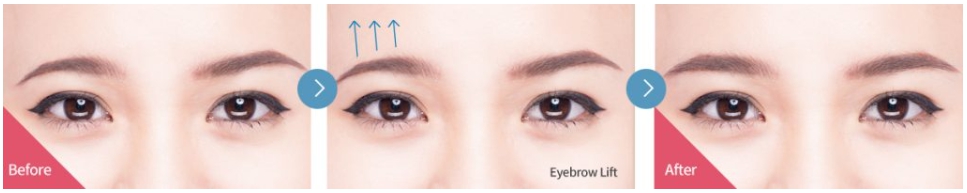 eyebrow lift korea before after