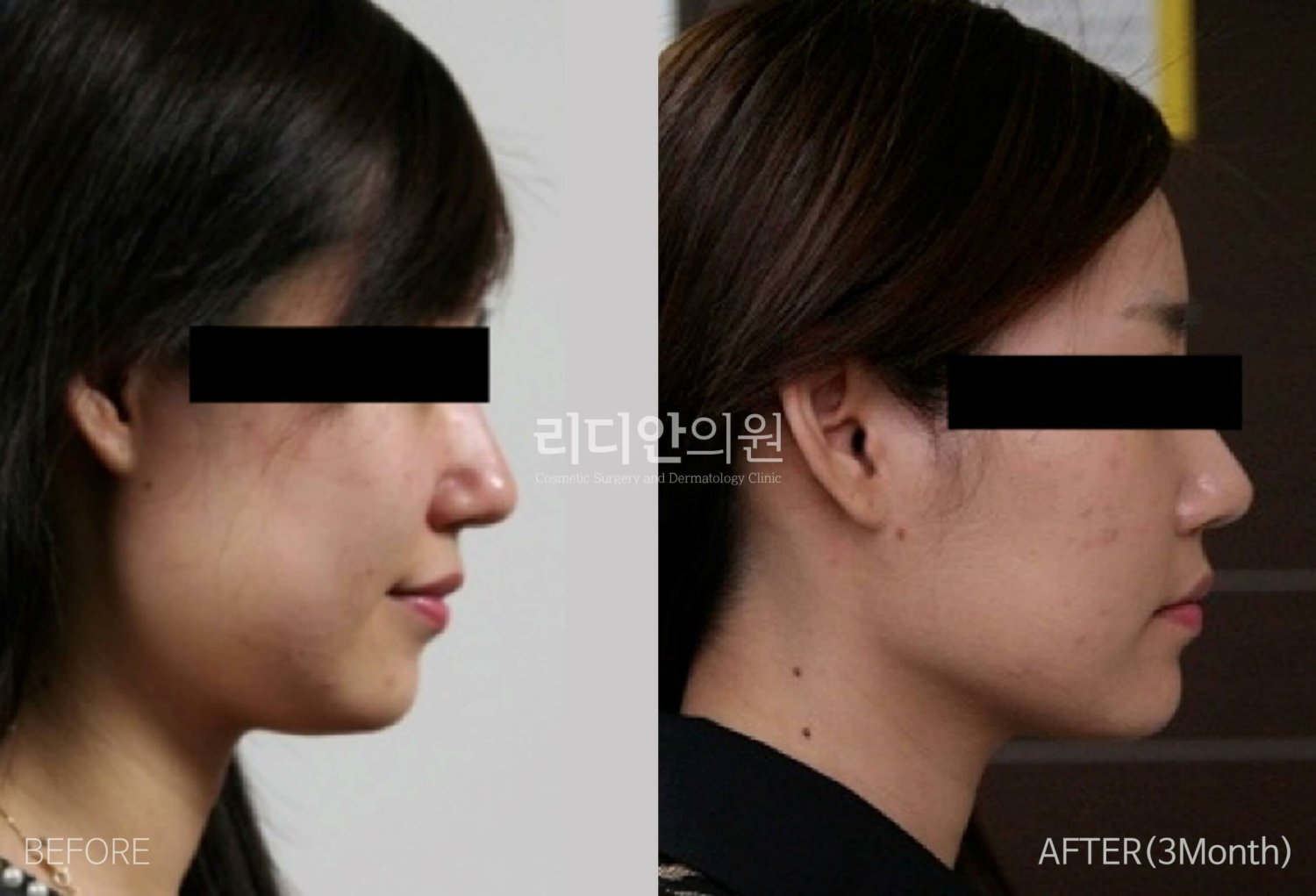 face liposuction korea before after