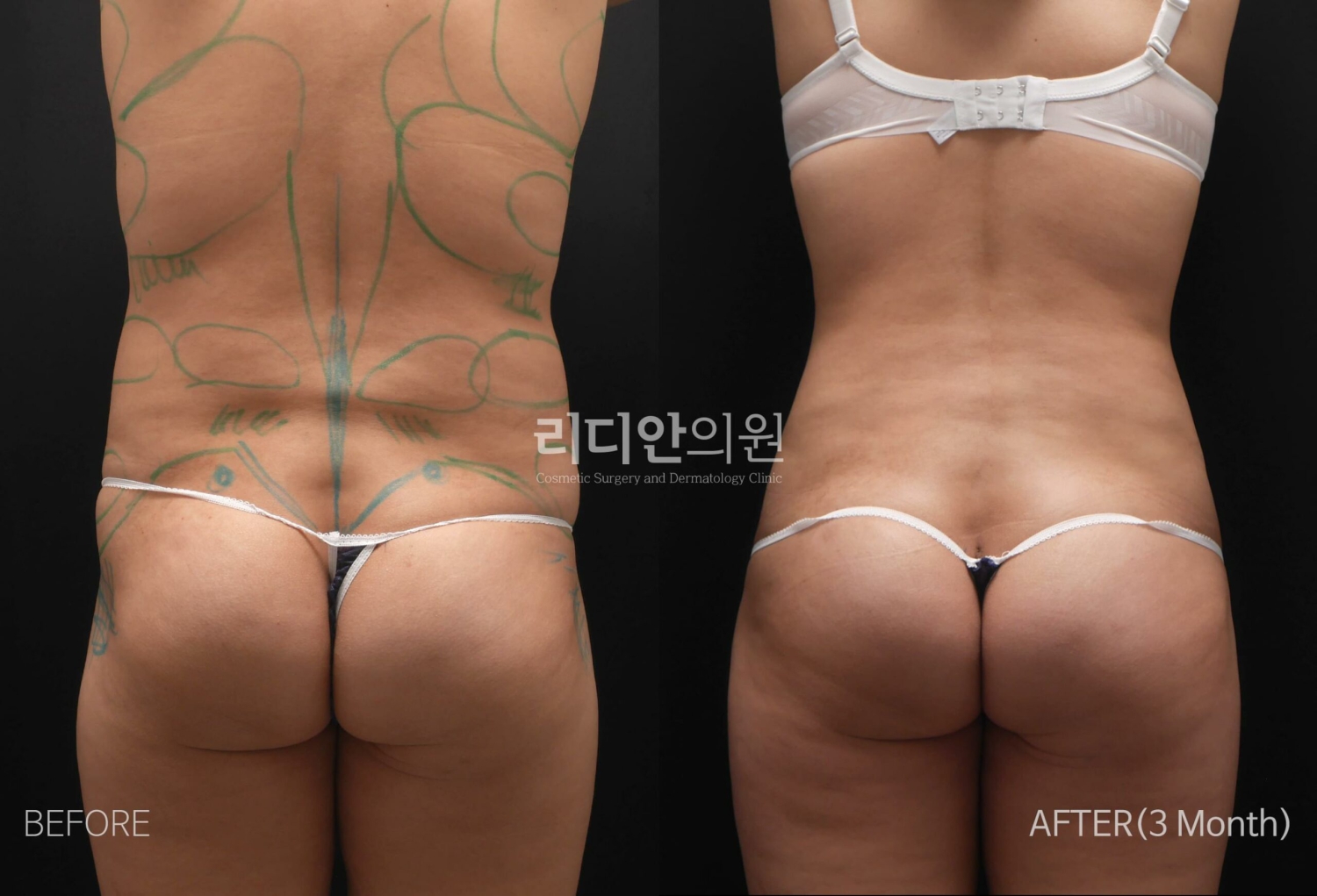 brazilian butt lift korea before after