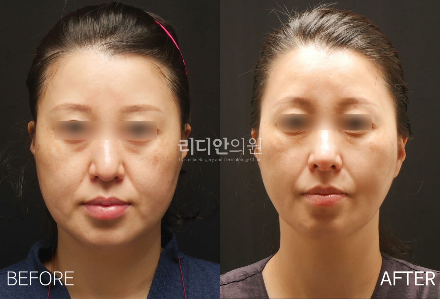 fat grafting korea before after
