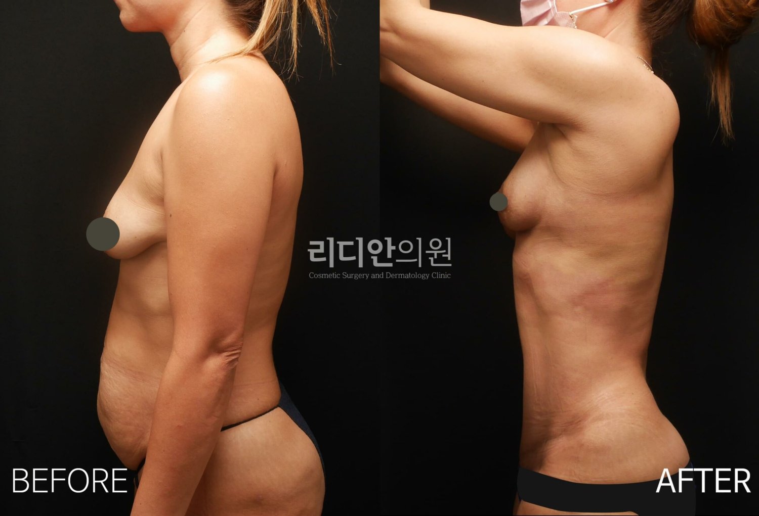 breast reduction korea before after
