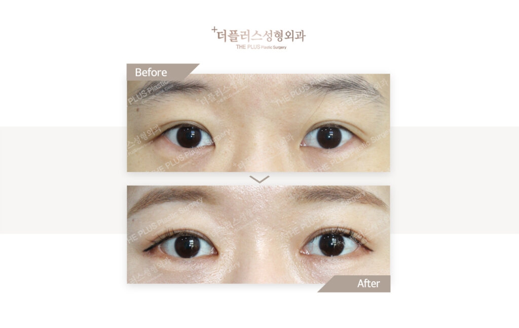 eye windening surgery korea before after