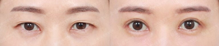 double eyelid surgery korea before after