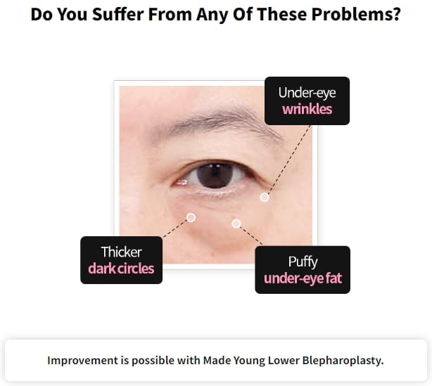 eyebag surgery korea