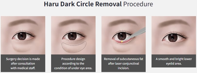 eyebag surgery korea cost