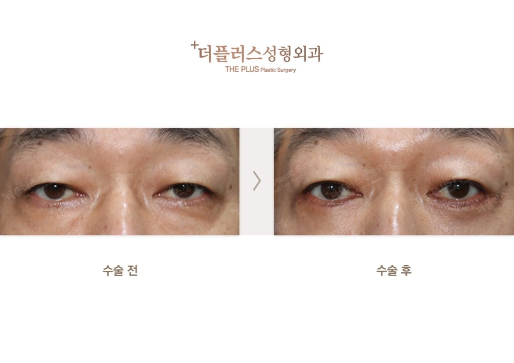 under eye surgery korea before after