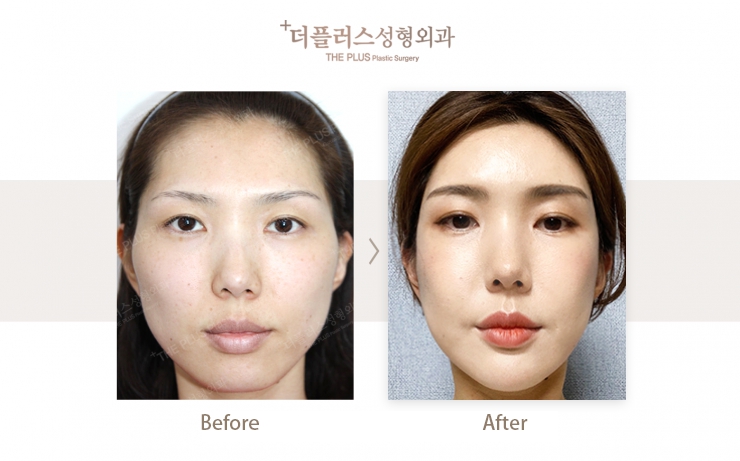 chin surgery korea