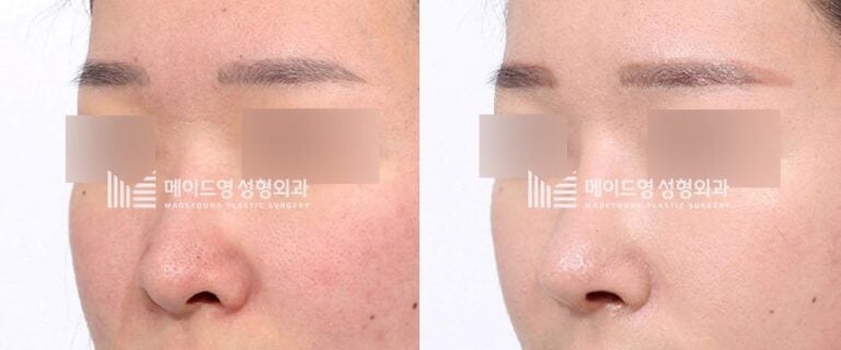 facial feminization surgery korea before after