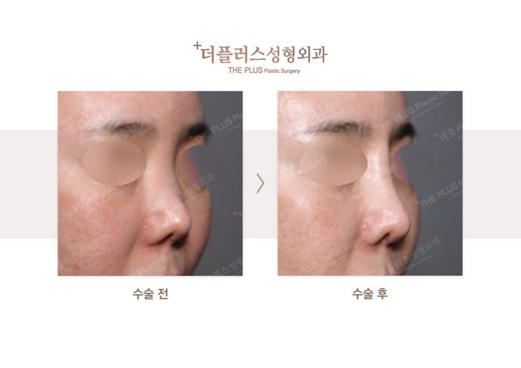 facial feminization surgery korea before after ffs