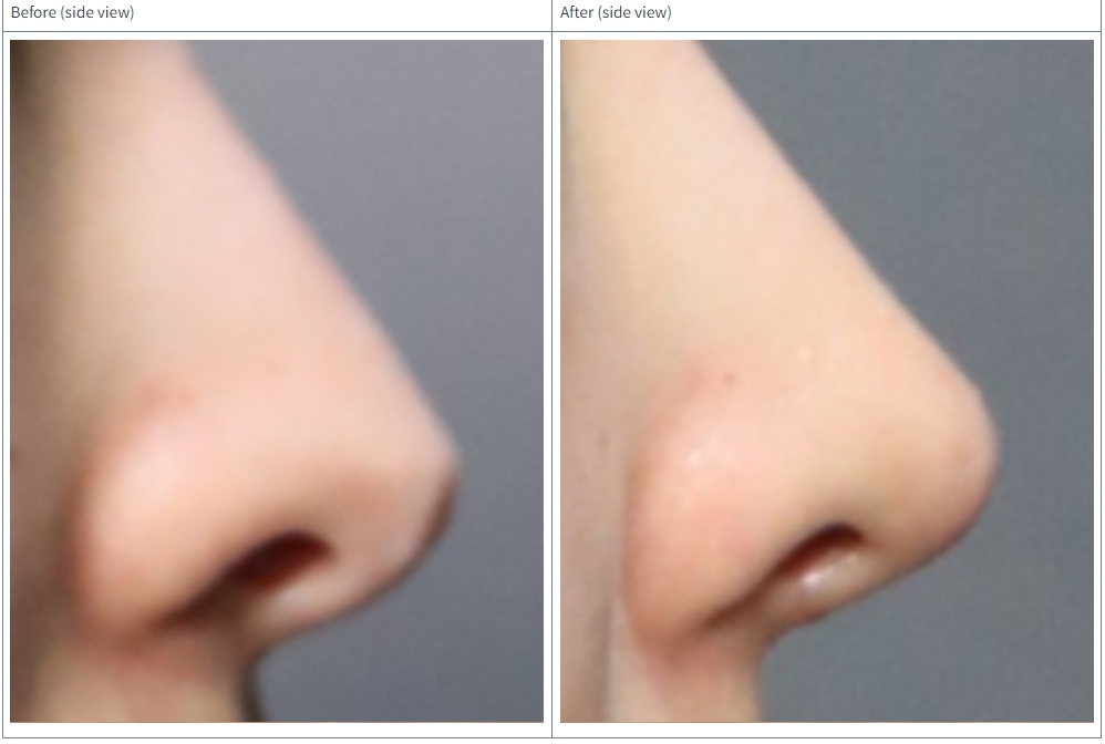 nose tip surgery korea before after