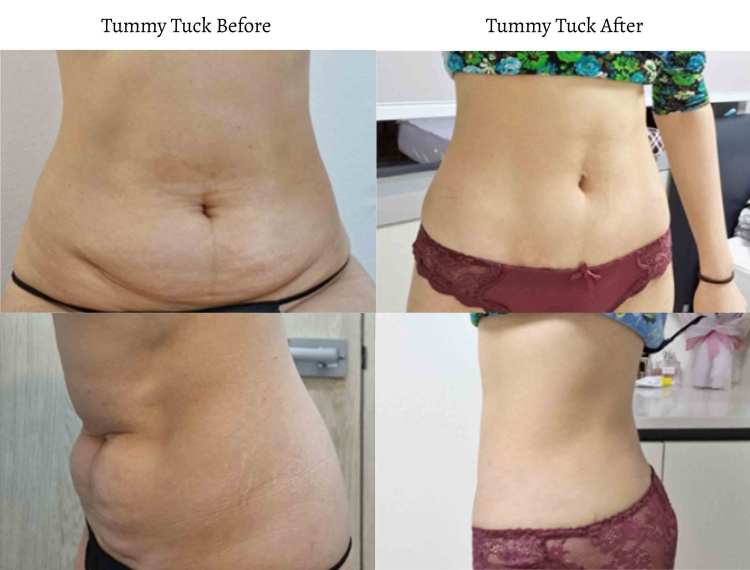 tummy tuck before after korea