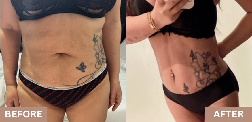 tummy tuck before after korea lydian