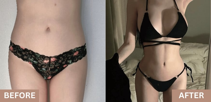 liposuction before after lydian korea