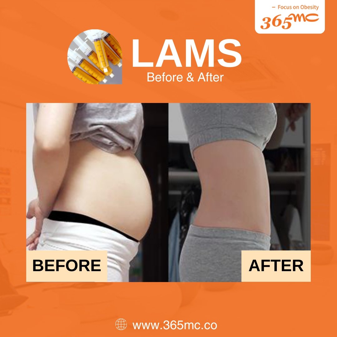 lams korea before after