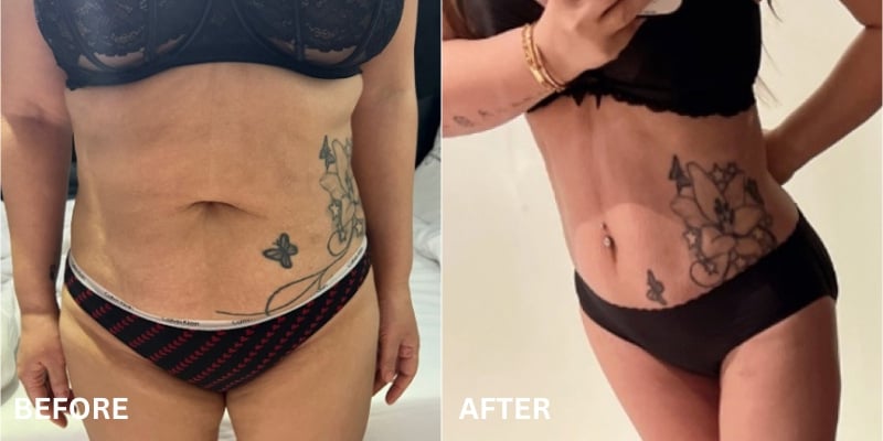 tummy tuck prima dopo corea