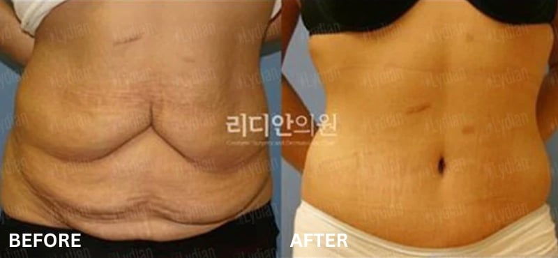 tummy tuck korea lydian before after