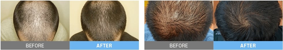 hair loss treatment korea