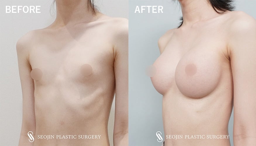 transgender breast implant korea