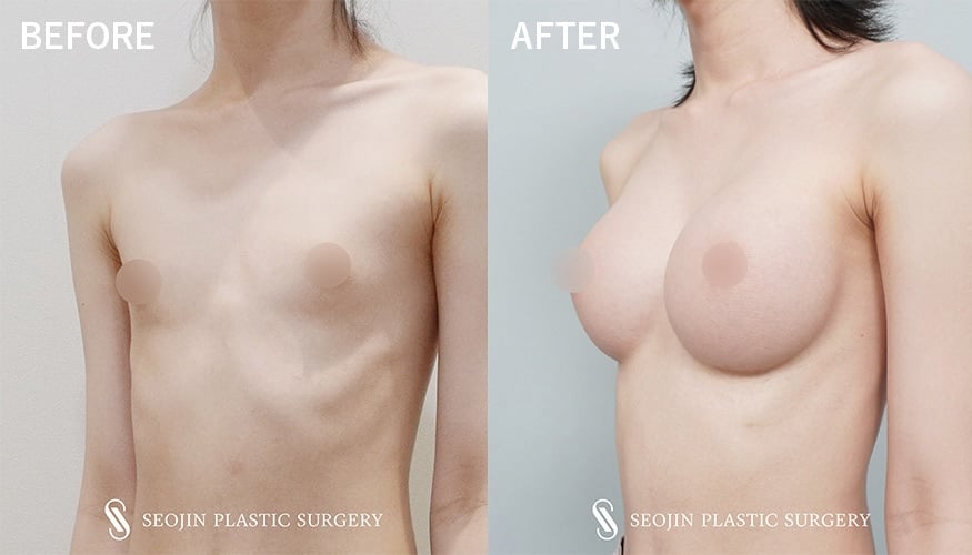 transgender breast implant singapore