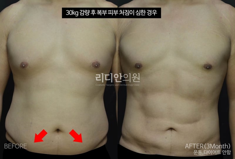 Plastic Surgery For Body Contouring