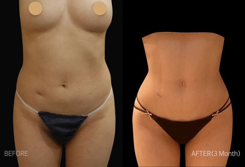Body Sculpting in Korea  Liposcultping Types, Best Clinics, Before After  Pictures and Costs of Sculpting in Korea