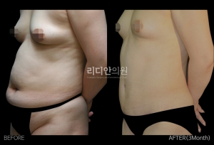 Body sculpting in korea before after