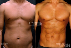 Body sculpting in korea cost