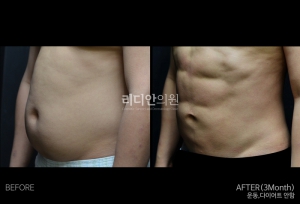 Body sculpting in korea 